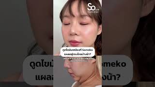 ดูดเหนียงมีแผลกี่จุด แล้วแผลใหญ่มั้ย  #somekoclinic #ดูดไขมันเหนียง #doublechinremoval #ลดเหนียง