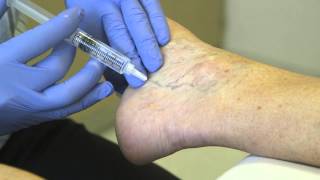 Spider Vein Treatment - Sclero Therapy