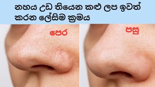 නාසයේ ඇති බ්ලැක් හෙඩ්ස් ඉවත් කරමු| How to remove blackhead at home