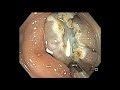 endoscopic resection of cancer study the polyp u0026 select proper technique