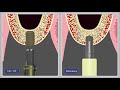 CAS KIT Drill vs Osteotome Comparison