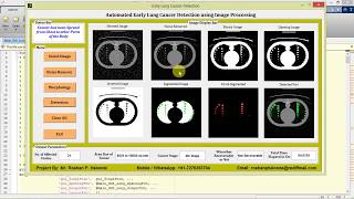 Early Stage Lung Cancer Detection using Image Processing Matlab Project Code