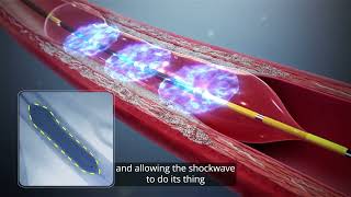 Cardiac Shockwave