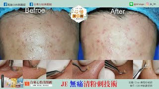 JE🔆SUN林凱晨老師🔺Big Acne🔺超大顆密集式粉刺🔺台東心怡美顏館🔺JE 無痛清粉刺技術