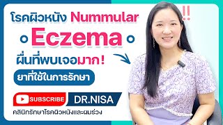 Nummular eczema ผื่นที่พบเจอมาก