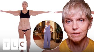 Beautiful Transformation - Woman Loses 7 Pounds of Excess Skin! | My Extreme Excess Skin
