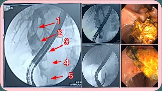 ERCP With Mechanical Lithotripsy !! ইআরসিপি করে পিত্ত নালীর পাথর বের করা #BD_ENDOSCOPY