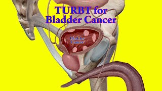 TURBT - How to do Transurethral Resection of Bladder Tumor - Bladder Cancer Surgery