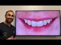 How composite can be used to transform your smile