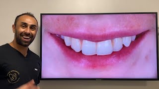 How composite can be used to transform your smile