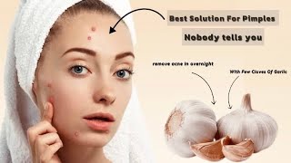 Say Goodbye to Acne and \u0026 Scars With Cloves Of Garlic | Best Solution to get rid Pimple Overnight