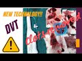 DVT clot removal new technique