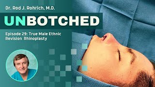 UNBOTCHED Episode 29  Male Ethnic Revision Rhinoplasty