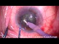 cataract surgery in an eye with two pterygia