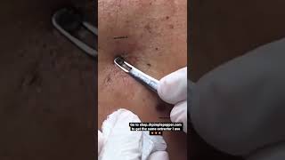 Satisfying Blackhead Extractions w/ Dr. Pimple Popper! 💥 #shorts