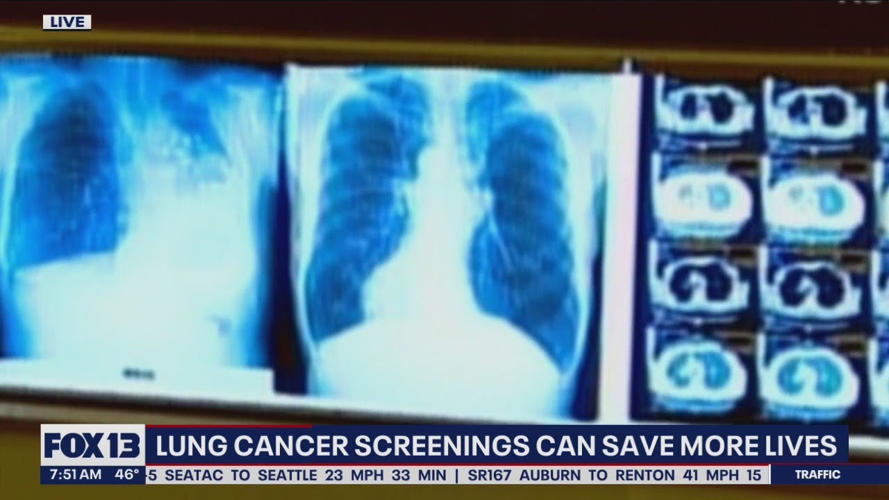 Lung Cancer Screenings Can Save More Lives | FOX 13 Seattle - YouTube