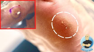 MYSTERY FOOT PAIN THAT DOCTORS/SPECIALISTS COULDN'T FIGURE OUT!!!! ***WHAT'S INSIDE?!***