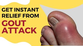 Get Instant Relief From Gout Attack | Homeopathy Treatment