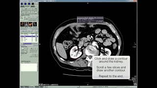 Vitrea Advanced segment using sculpt demo