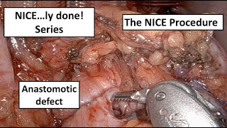 NICE…ly done! How To Repair A Defect At The Anastomosis During The NICE Procedure