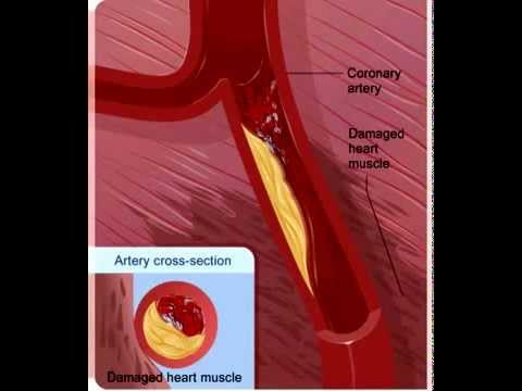 Heart Attack Animation Youtube