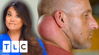 Dr. Lee Removes This Patient’s Second Head Growing On His Neck! | Dr. Pimple Popper