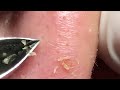 relax satisfying nose blackheads tweezers acne treatment 鼻角栓 ピンセット 피지제거_038