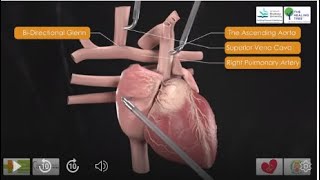 Evolution of the Fontan Procedure 3D Medical Animation