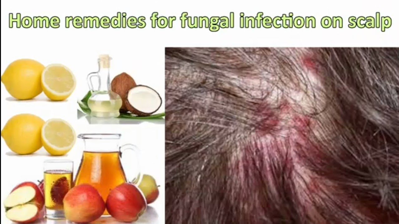 Scalp Fungus Home Remedy