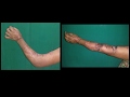 Post burn elbow contracture -  Release and flap