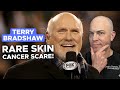 Doctor Explains Rare Skin Cancer