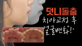 덧니돌출입교정, 얼굴변화 있을까? (치아교정전후, 발치교정🦷)