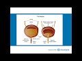 ohiohealth multiple sclerosis lecture bladder bowel and sexual dysfunction in ms