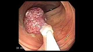 Endoscopy Polypectomy of Polyp of Descending Colon