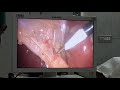 Laparoscopic Cholecystectomy with Critical View of Safety (CVS) Dr. Manzar Ali Laparoscopic Surgeon