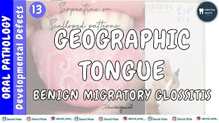 Benign migratory glossitis | Geographic Tongue | Wandering rash of tongue | Dr Paridhi Agrawal