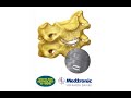 Medtronic: BRYAN Cervical Disc Implant Features