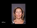 live revanesse brow lift including before after verso surgery centre