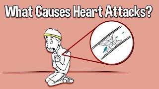 What Causes Heart Attacks?