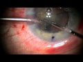 Stephen Slade MD Laser Cataract: New Technique