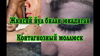 #Doktorspb Жинсий йул билан юкадиган Контагиозный моллюск