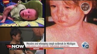 Measles and whooping cough outbreak in Michigan