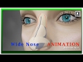 Rhinoplasty Animation - How can a Wide nose be narrowed?