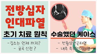 전방십자인대파열 시즌2-7 - 초기치료원칙