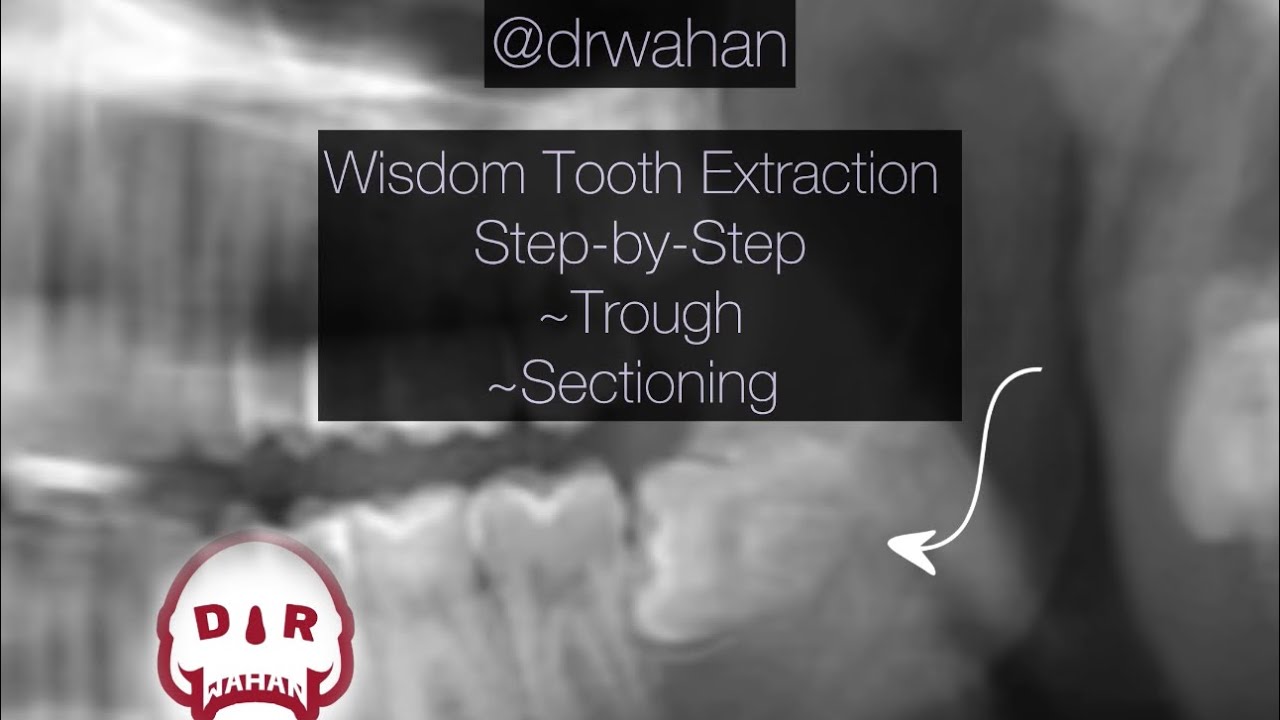 Step By Step Wisdom Tooth Extraction Video With Sectioning @drwahan ...