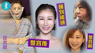 【獨家整容片段】歌手迪子韓國抽臀脂放入塊面 削骨隆鼻 兩周腫到似豬頭