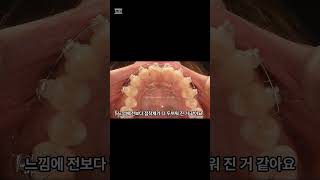 교정장치 떨어져서 붙이고 왔는데요. 접착제가 두꺼운 거 같아요.  #교정중생기는 #프라임S치과