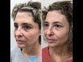 REVERSE THE SIGNS OF AGING with Sciton Lasers Options: BBL, Halo, TRL, CO2