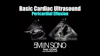 The POCUS diagnosis of a Pericardial Effusion: A Practical Guide for Clinicians