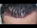 day 1 after smart fue hair transplant